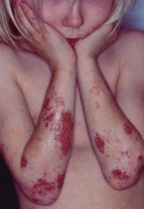 Atopisk dermatitis på underarmene hos en pige