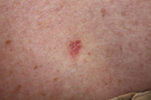 Basalcellekræft i huden
