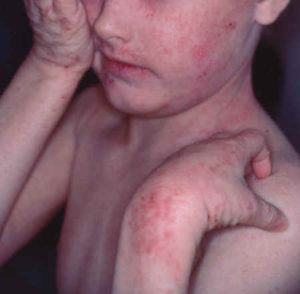 Børnesår med infektion (stafylokokker) 