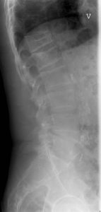 Knogleskørhed i ryggen hos en patient