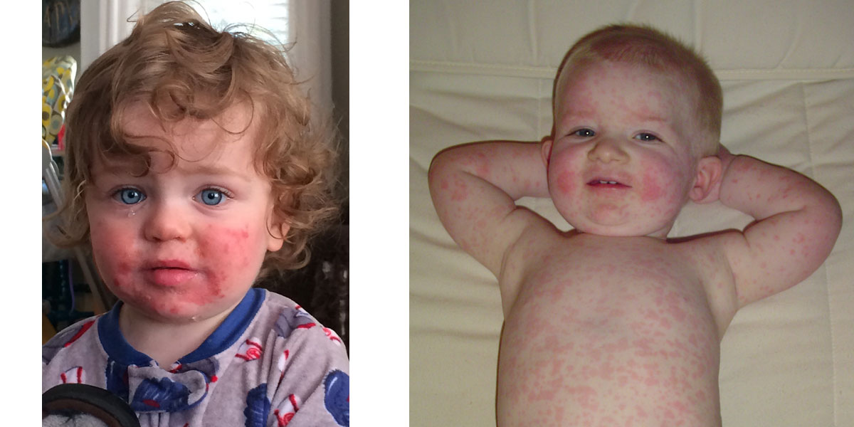 lussingesyge-den-femte-b-rnesygdom-symptomer-smitte-osv