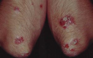 Psoriasis plaques (på albuerne)