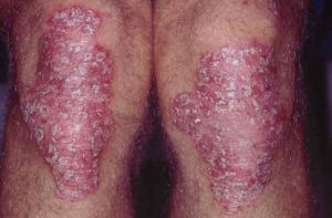 Psoriasis på knæene