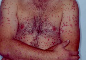 Psoriasis på overkroppen og arme