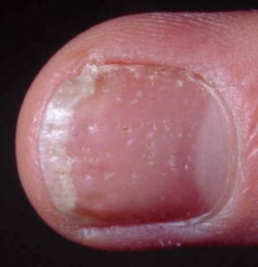 Negl med psoriasis